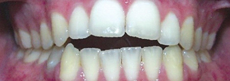 Before Treatment
