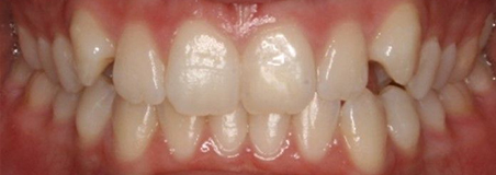 Before Treatment