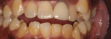 Before Treatment