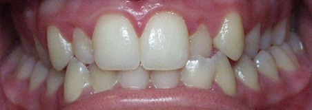 Before Treatment