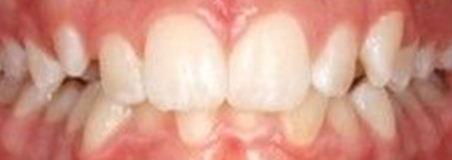 Before Treatment