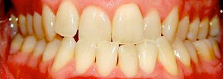 Before Treatment