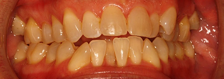 Before Treatment