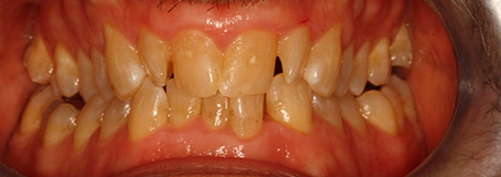 Before Treatment