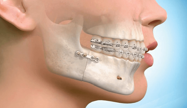 What are the risks associated with orthognathic surgery? - Quarry Orthodontics in Baltimore, MD
