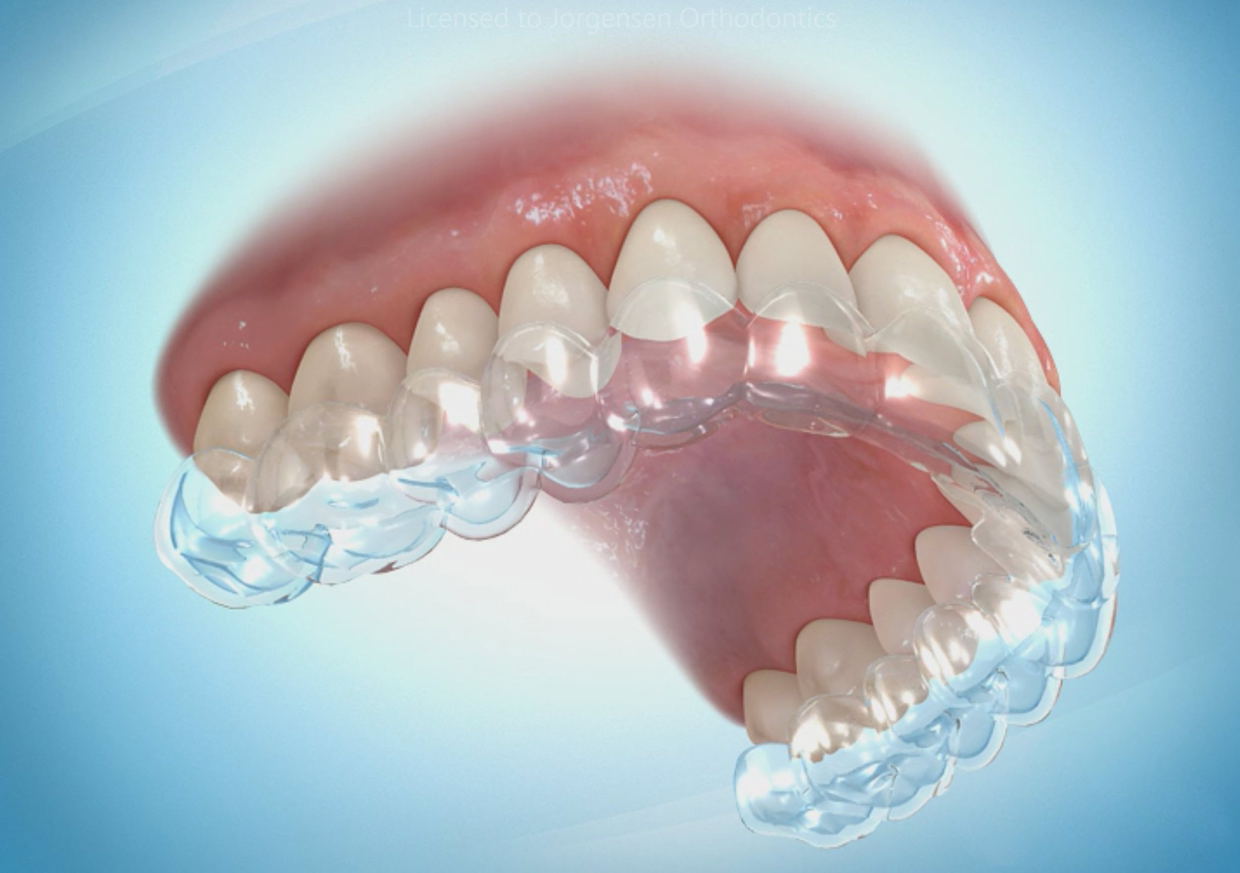 How do clear aligners work? - Quarry Orthodontics in Baltimore, MD