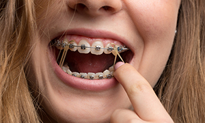 Types of Appliances - Quarry Orthodontics in Baltimore, MD