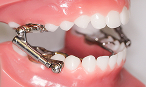 Elastics (Rubber Bands) - Quarry Orthodontics in Baltimore, MD