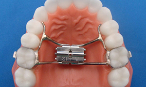 Herbst Appliance - Quarry Orthodontics in Baltimore, MD