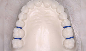 Retainers - Quarry Orthodontics in Baltimore, MD