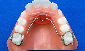 Separators or Spacers - Quarry Orthodontics in Baltimore, MD