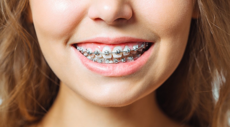 Self-Ligating Braces - Quarry Orthodontics in Baltimore, MD
