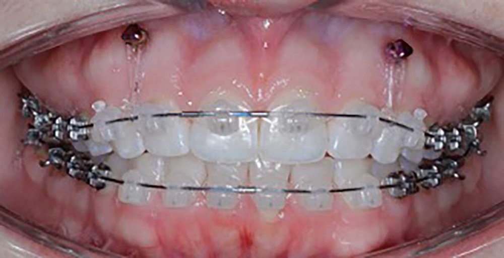 Temporary Anchorage Device (TAD) Titanium Pins - Quarry Orthodontics in Baltimore, MD