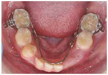 Nance Appliance - Quarry Orthodontics in Baltimore, MD